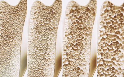 Osteoporosi, definita la “ladra silenziosa”. Una malattia che erode le ossa lentamente