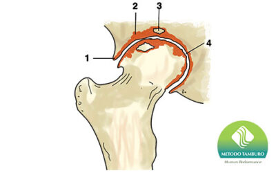 La coxartrosi, un processo degenerativo che colpisce l’articolazione dell’anca